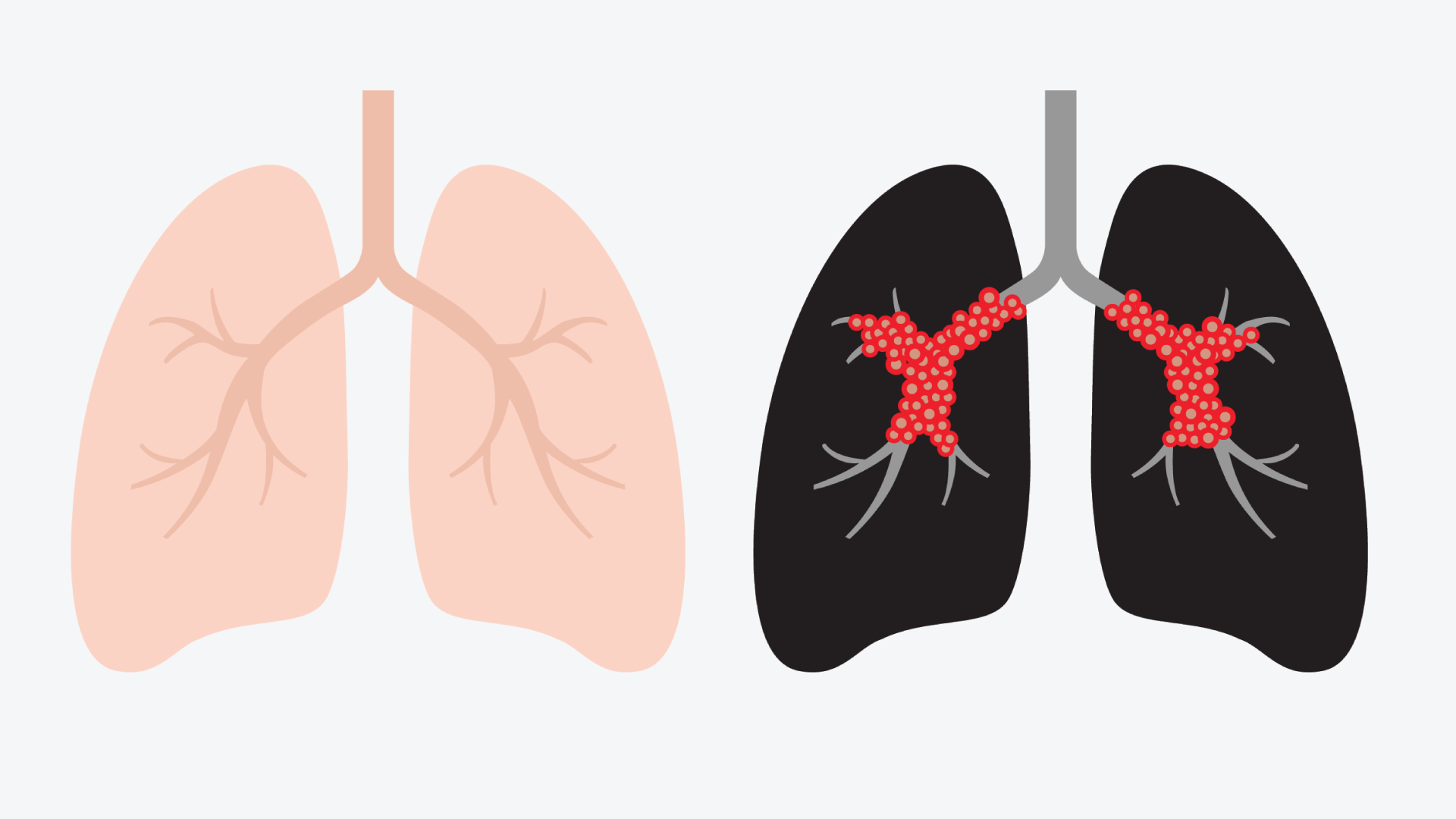 Płuca zdrowego człowieka